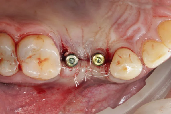 配線された歯茎を持つ歯科インプラントの2つのプラグ — ストック写真