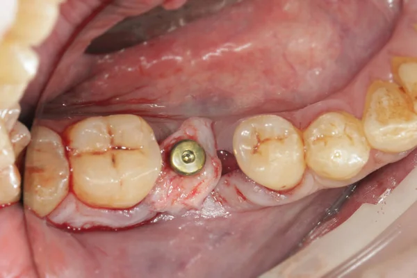 Βύσμα Οδοντικό Εμφύτευμα Και Συσσώρευση Μαλακών Ιστών — Φωτογραφία Αρχείου