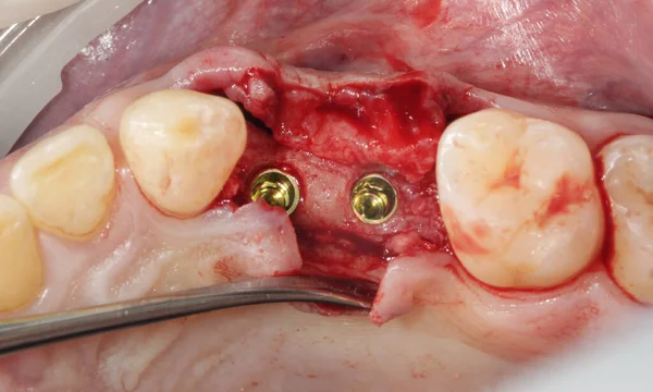 Implants Dentaires Deux Gencives Sectionnelles — Photo