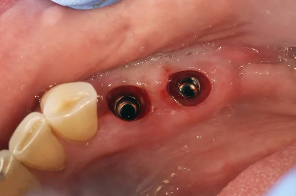 Οδοντιατρική Βάση Μετά Την Εμφύτευση Προετοιμασία Για Κορώνες — Φωτογραφία Αρχείου