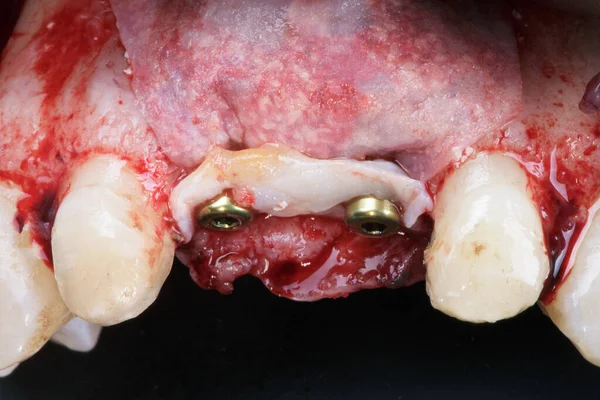 Implante Complexo Com Uma Membrana Dos Tecidos Moles Nos Incisivos — Fotografia de Stock