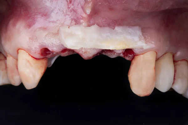 フロントインジケータと着床後の軟部組織を持つ歯茎 — ストック写真