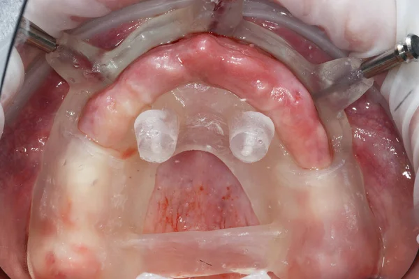 Modello Stabilito Riduzione Della Cresta Chirurgia Dentale — Foto Stock