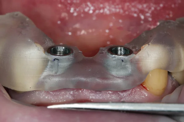 歯の上に描く2つの クローズアップのための歯科インプラントテンプレート — ストック写真