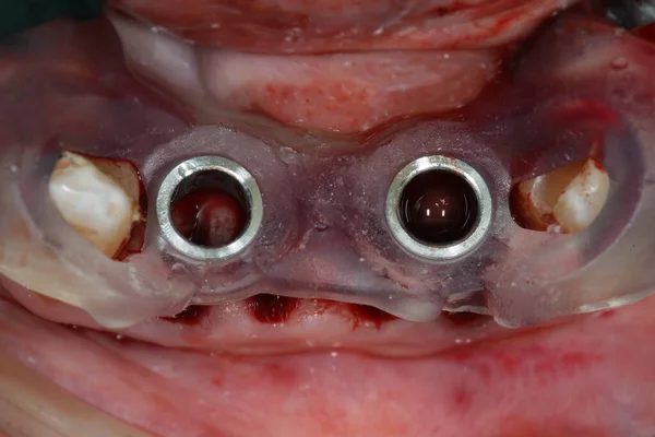 Macro Photo Template Implantes Dentales Menores Dos Años —  Fotos de Stock