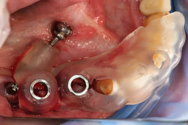 手術中に正確に移植するための歯科標準テンプレート — ストック写真