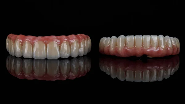 Excelente Composición Sobre Prótesis Dentales Cerámica Vidrio Negro Con Encías —  Fotos de Stock