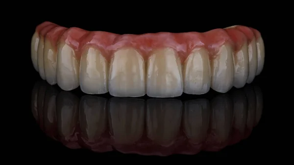 Excelente Tiro Uma Prótese Dentária Mandíbula Superior Feita Titânio Cerâmica — Fotografia de Stock