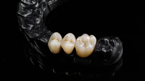 Três Coroas Dentárias Cerâmica Área Mastigação Modelo Preto — Fotografia de Stock