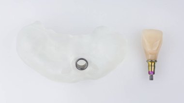 Merkezi diş implantı ve çekirdeği için diş kalıbı, beyaz arka planda üst görünüm