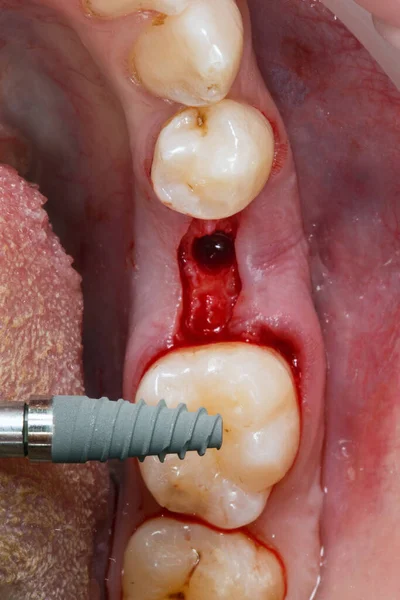 Kemiğe Yerleştirmeden Önce Diş Implantı — Stok fotoğraf