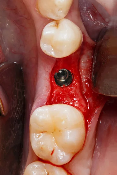 骨に設置された歯科インプラントの明るいマクロ写真 — ストック写真
