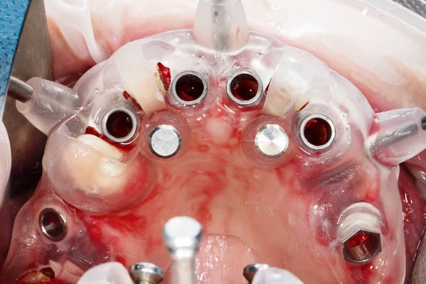 Modello Chirurgico Dentale Installazione Sei Impianti Nella Mascella Superiore — Foto Stock