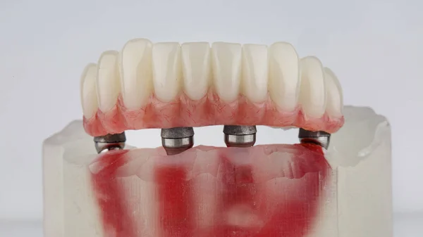 Prótesis Dental Mandíbula Inferior Con Goma Rosa Viga Metal Sobre — Foto de Stock