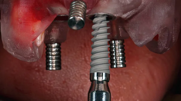 Mplant Dişçisine Özel Bir Kurulum Doğruluk Şablonu Ile Giriş Anı — Stok fotoğraf
