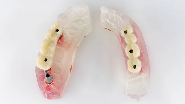 Два Временных Зубных Протеза Моделях Вид Сверху Белом Фоне — стоковое фото