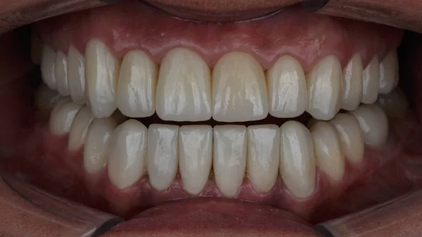 患者の口の中でセラミック歯科用ベンダーと王冠との総作業 — ストック写真