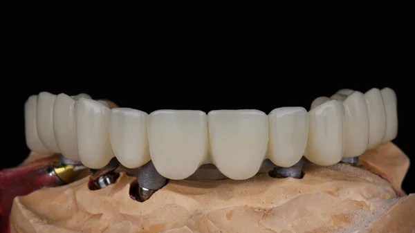 Üst Çene Için Diş Protezi Kirişli Model Üzerinde Siyah Arkaplan — Stok fotoğraf