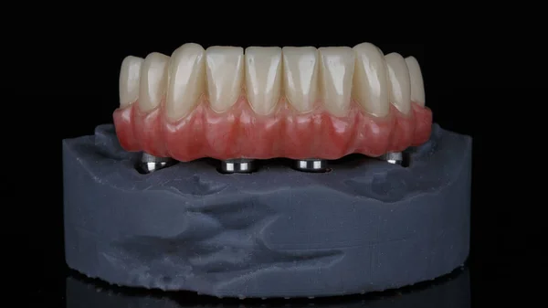 下顎のためのピンクの歯茎と解剖学的構造を持つ美しい歯科補綴物は 黒の背景に撮影されました — ストック写真