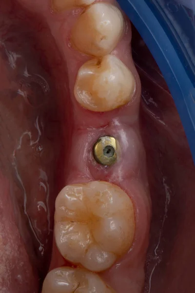 2週間の着床後に形成者による歯科で健康なガム — ストック写真