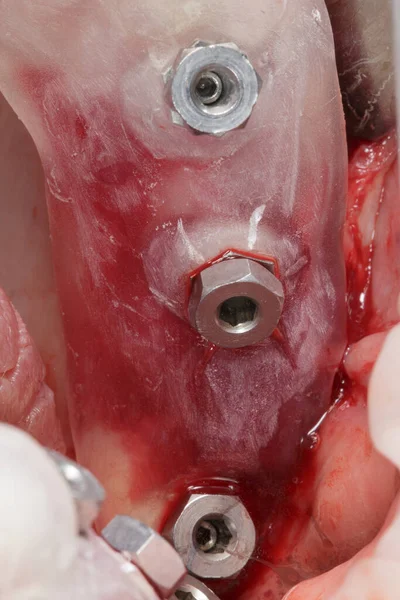 Tre Protesi Dentali Montate Attraverso Una Sagoma — Foto Stock