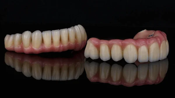 ピンクのガムで金属とセラミックで作られた2つの歯科用義歯の優れた組成 創造的な反射と黒のガラス上の写真 — ストック写真