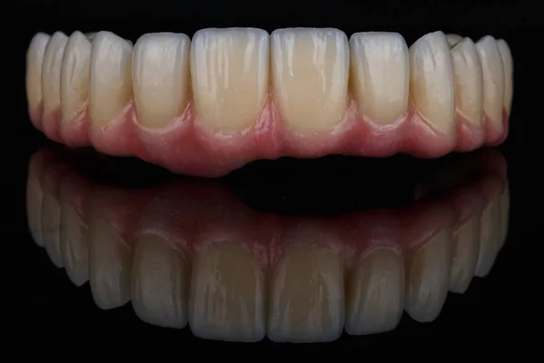 Excelente Prótese Dentária Mandíbula Superior Cerâmica Metálica Com Uma Gengiva — Fotografia de Stock