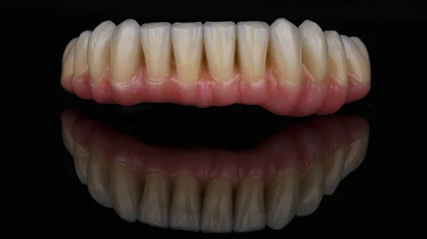 Dental Prosthesis Lower Jaw Metal Ceramic Pink Gum Black Background — Stock Photo, Image