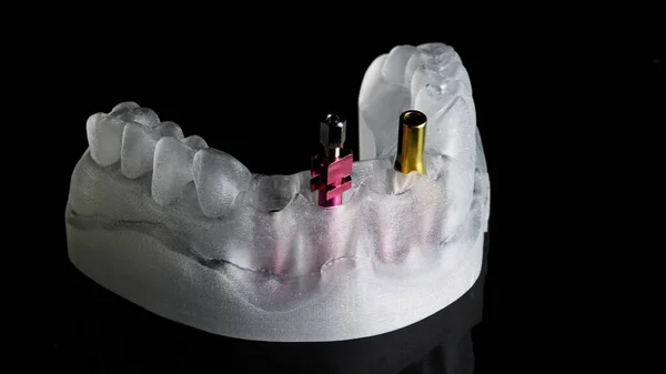 Prótese Dentária Para Ortopedia Modelo Plástico Sobre Fundo Preto — Fotografia de Stock