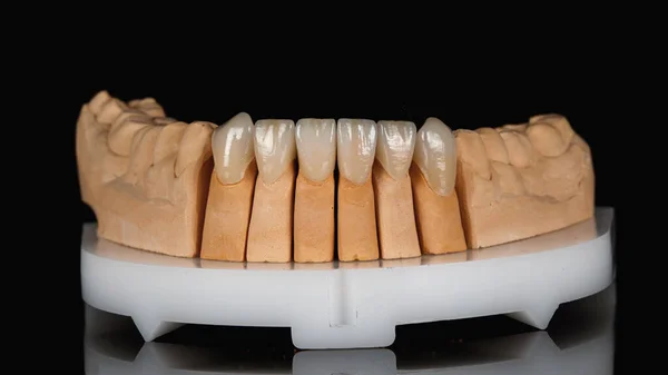 Modello Dentale Della Mascella Inferiore Con Impiallacciatura Ceramica — Foto Stock
