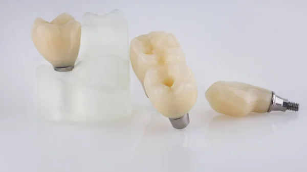 Coronas Dentales Desplegadas Para Masticar Los Dientes Sobre Fondo Blanco —  Fotos de Stock