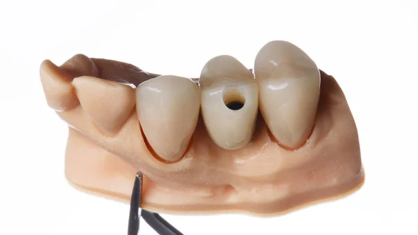 Зубные Коронки Специальной Модели Снятые Белом Фоне — стоковое фото