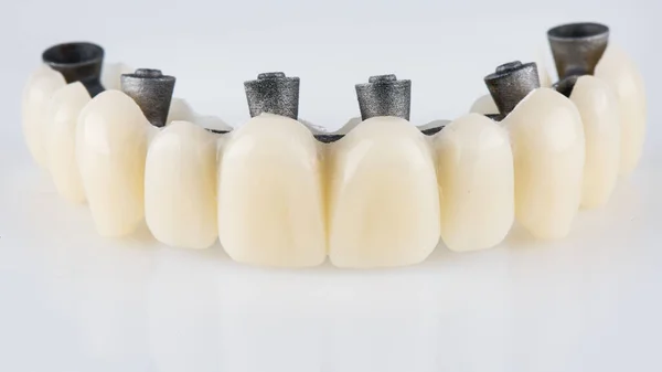 Beyaz Arkaplanda Metal Kiriş Ile Üst Çenenin Diş Protezi — Stok fotoğraf