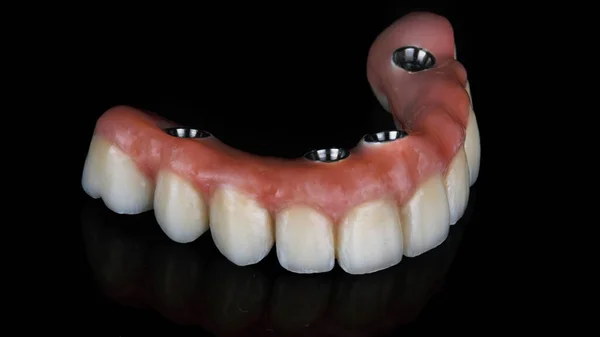 Bovenste Kaak Prothese Gemaakt Van Keramiek Met Roze Gingiva Titanium — Stockfoto