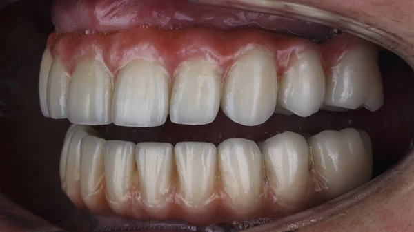 口腔内の上顎および下顎のための高品質のセラミック歯科用義歯 — ストック写真
