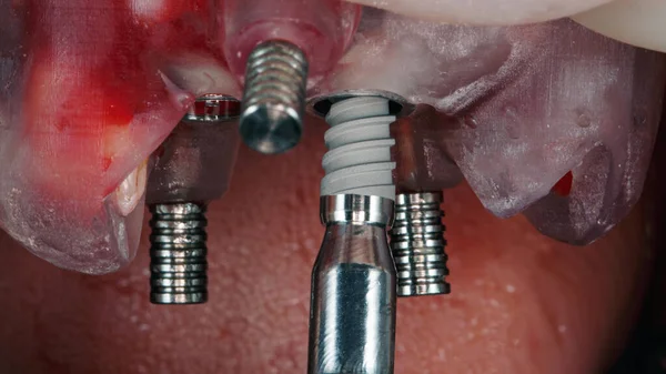 Üst Çene Cerrahi Şablon Aracılığıyla Bir Diş Implantı Kurulumu Için — Stok fotoğraf