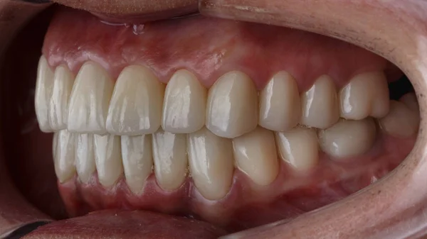 beautiful teeth with ceramic dental crowns and inlays in the patient\'s mouth