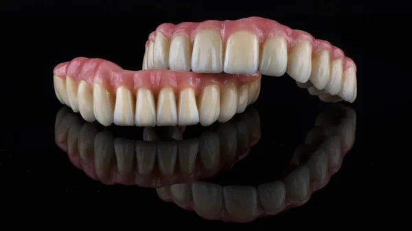 Excelente Composición Prótesis Dentales Cerámica Titanio Foto Sobre Vidrio Negro —  Fotos de Stock