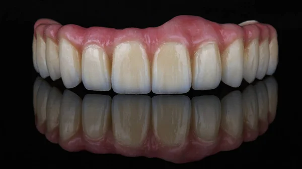 Prótese Dentária Perfeita Feita Cerâmica Com Uma Gengiva Rosa Sobre — Fotografia de Stock