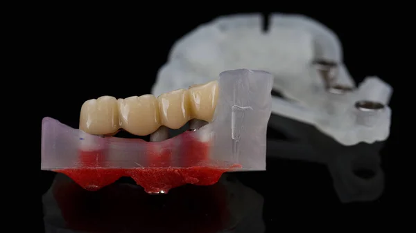 Zubní Most Protéza Žvýkání Zubů Pozadí Chirurgické Šablony Černém Pozadí — Stock fotografie