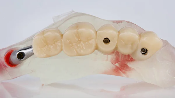 白い背景に5本の歯の歯科補綴物 — ストック写真