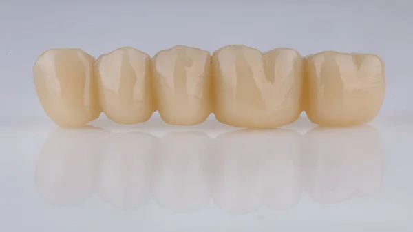 白底塑料制5颗假牙的临时磨损假肢 — 图库照片