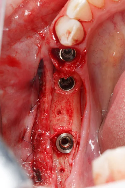 骨に歯科用インプラントを3つ設置し — ストック写真
