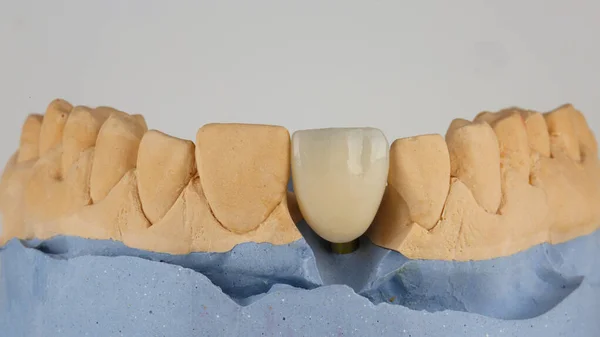 Corona Dentale Ceramica Del Dente Centrale Modello Con Sfondo Bianco — Foto Stock