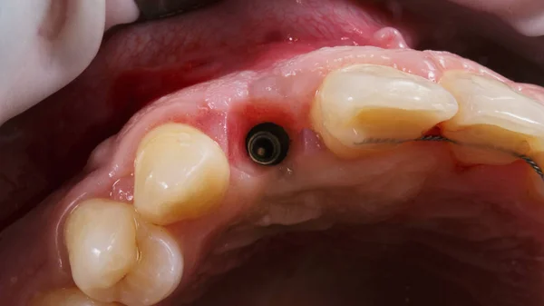 中央の歯に埋め込まれたインプラントの鏡を通して見ることができます — ストック写真