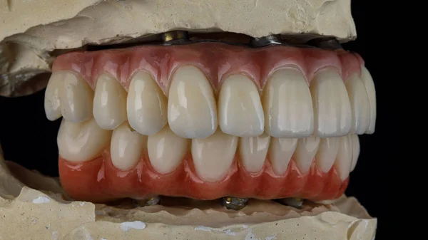 黒の背景にかまれたモデルに人工的な歯茎を持つ2本の顎のためのセラミック義肢 — ストック写真