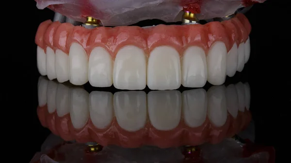 Prótese Dentária Temporária Feita Plástico Com Gengivas Artificiais Sobre Modelo — Fotografia de Stock
