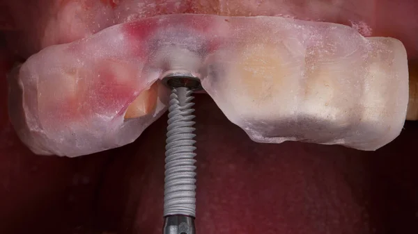 Merkezi Diş Implantını Özel Bir Şablonla Yerleştirmeden Önce Çok Güzel — Stok fotoğraf