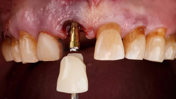 Dişinizin Merkezindeki Diş Kaplamasının Yerleştirilme Anı — Stok fotoğraf