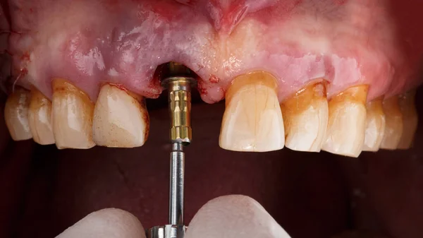 歯の中心部への歯科移植後の個々のアバットメントの設置 — ストック写真
